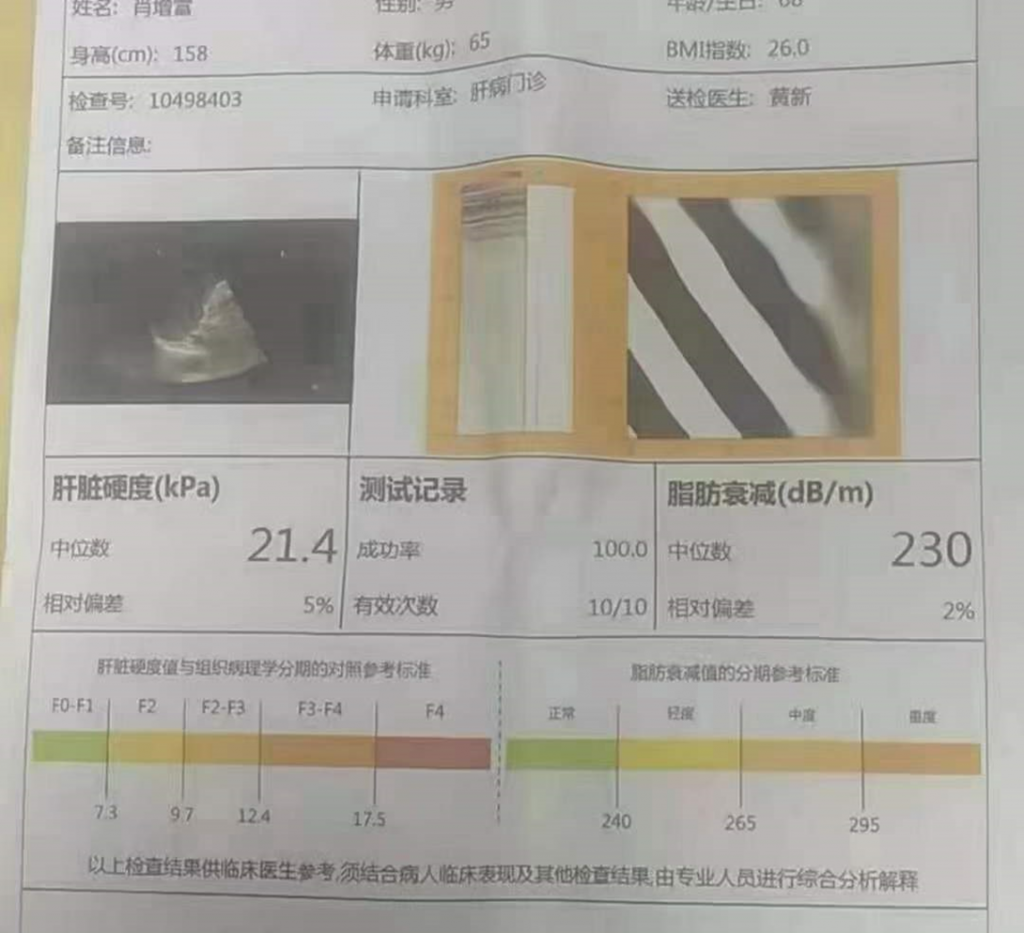 服用龙牙肝泰前,肝硬度21.4